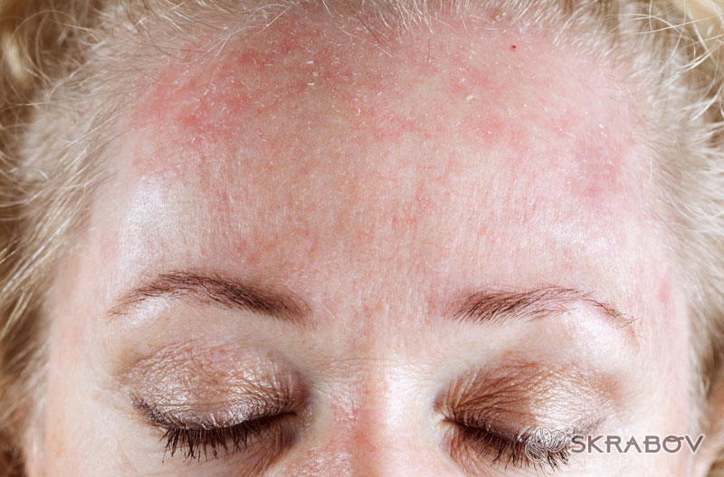 Как избавиться от аллергии на лице и не пропустить первые симптомы 10-3-1